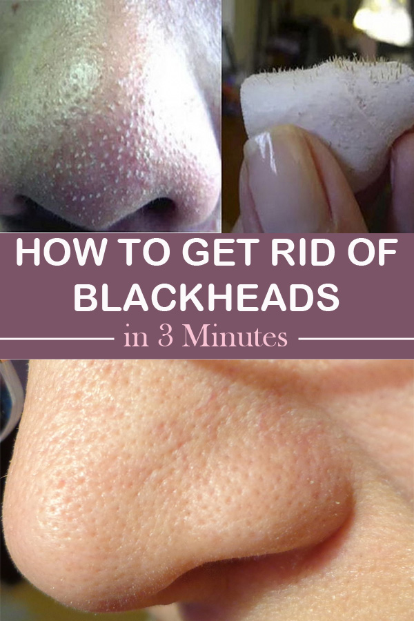 How To Get Rid Of Blackheads in 3 Minutes? 